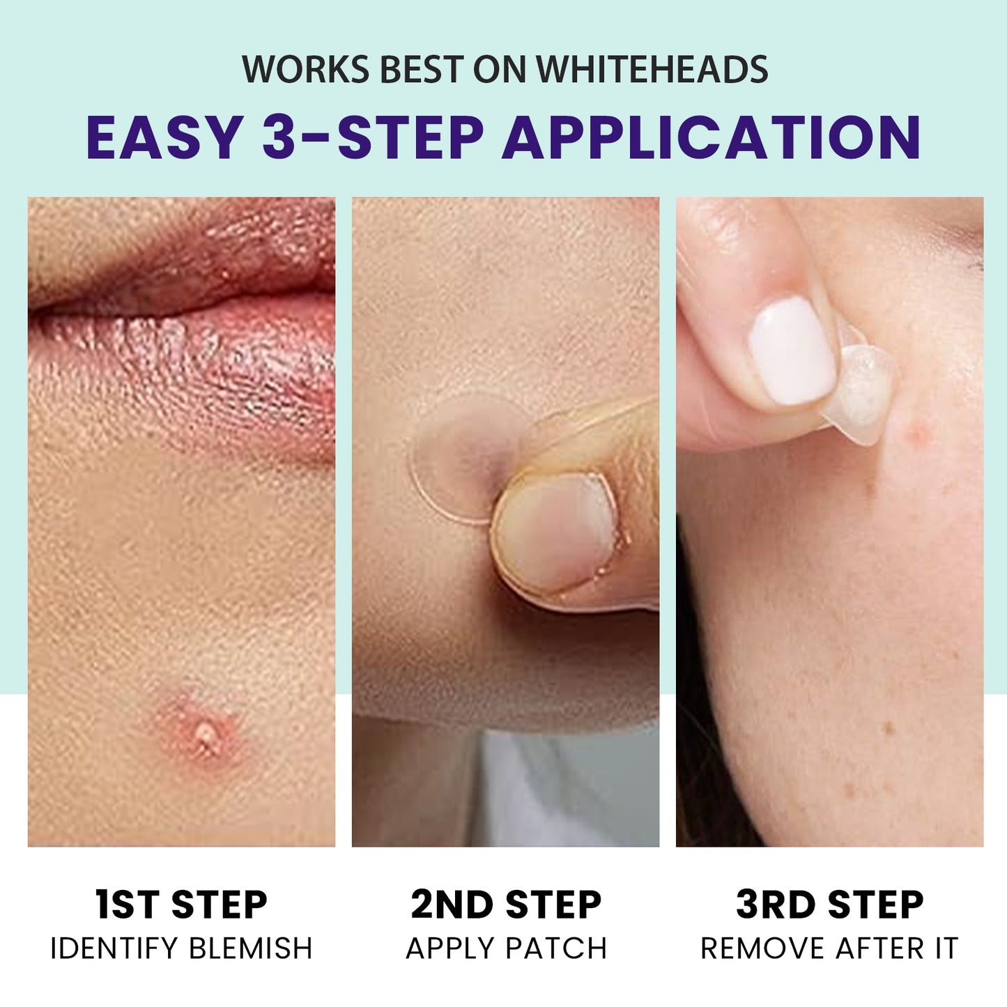 Hydrocolloid Acne Patches 36 Count Pimple Treatment